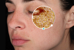 VISIA: ���������� ����