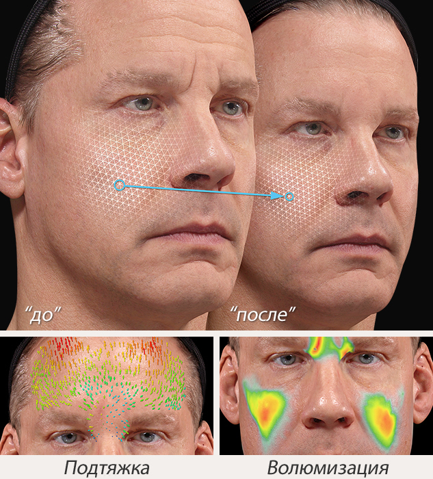 VECTRA H2: ���������� ������������� ������������