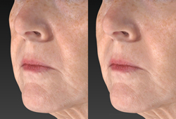 VISIA 3D: ��������������