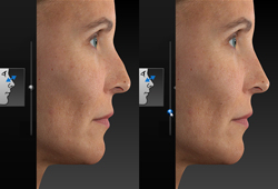 VISIA 3D: ����������� �������������