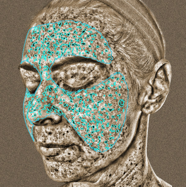 VISIA 3D: ������������� ����������� ���� - ��-�����